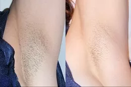 ازالة شعر